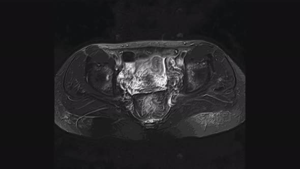 Voluminous MRI of the Female Pelvic Organs, Abdominal Cavity, Gastrointestinal Tract and Bladder