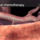 regional chemotherapy - VideoHive Item for Sale
