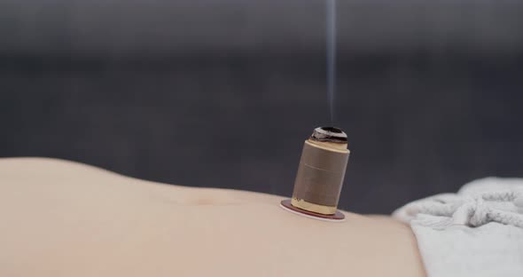 Woman undergo moxibustion therapy on her body