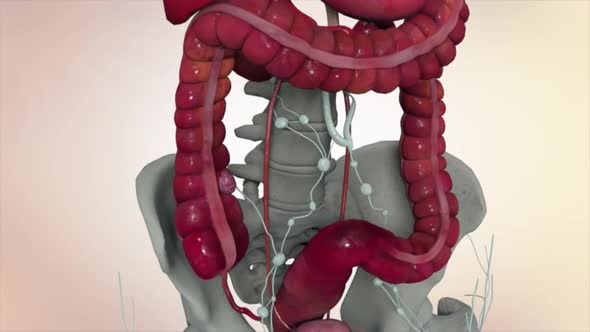 Colon during a enteroscopy with a intestinal or bowel cancer tumor visible.