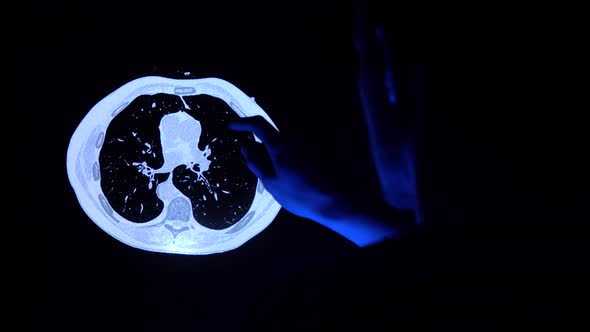 Doctor with a pen checking a tomography scan of lungs with cancer tumor