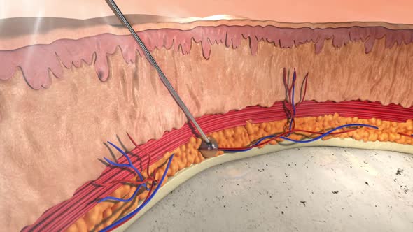 3d animation of hyaluronic acid injection. Section of skin and epidermis with needle