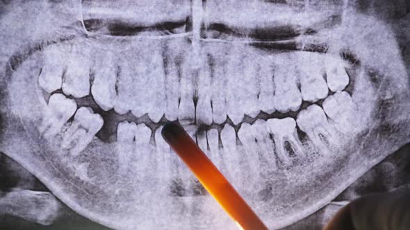 Dental XRay of Jaw with Teeth