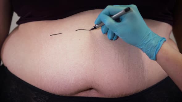 Close-up of Female Caucasian Hand Drawing Lines on Fat Woman's Belly. Plastic Surgeon Preparing