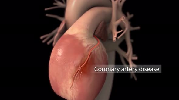 Carotid Artery Disease 3D Medical Animation