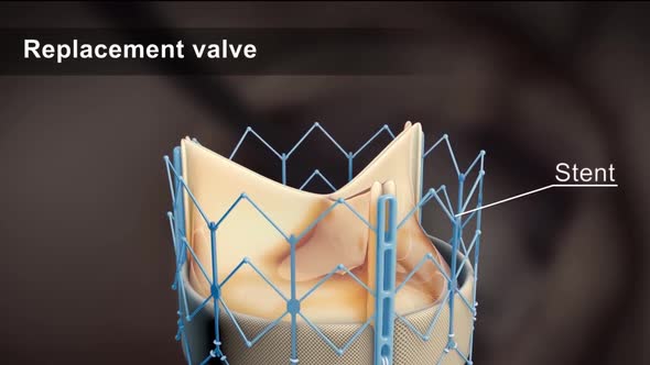 An artificial heart valve is inserted instead of a dysfunctional heart valve.