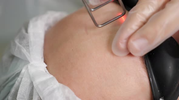 Hands Do Laser Rejuvenation on Woman Forehead Close View