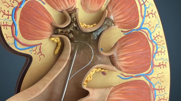 Kidney Stone Treatment. Lithotripsy.