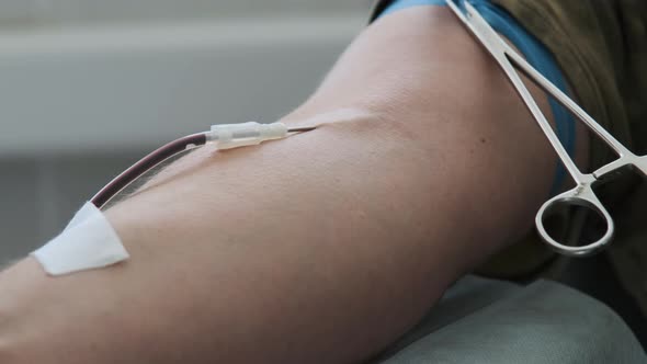 Close Up Footage Arm of Man Who Donated Blood. COVID 19 Plasma Donation. Man Squeeze Arm for Making