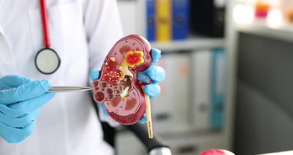 Nephrologist Holding Model of Human Kidney in Clinic