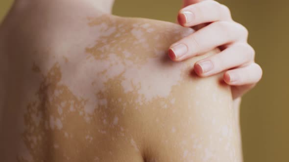 Vitiligo.  Close up shot of female body with uneven pigmentation