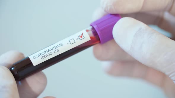 Test for Coronavirus in a Hand of Physician