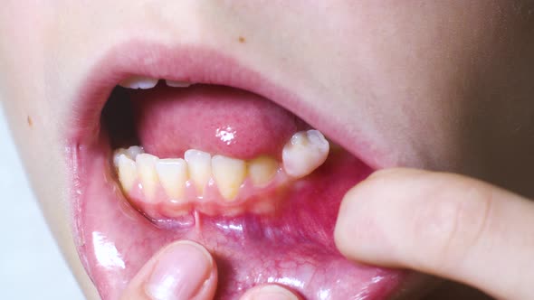 Macro of Shaky Baby Tooth in Cavity of Child