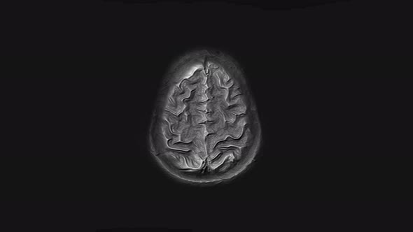 Voluminous MRI Brain, Head Scans and Tumor Detection. Diagnostic Medical Tool