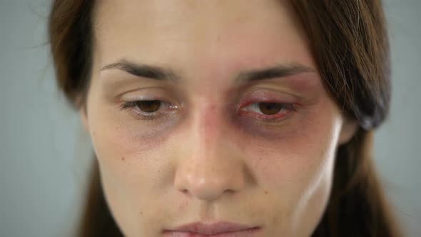 Woman With Bruise on Face Sadly Looking at Camera, Victim of Assault in Family