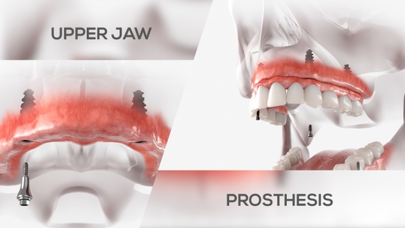 Maxillary Prosthesis