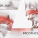 Maxillary Prosthesis - VideoHive Item for Sale