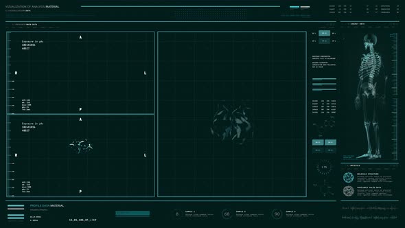 Scanner has identified the brain tumor after the patient examination at hospital alt