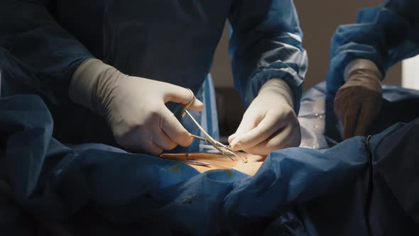 Surgeons Sew Up the Patient's Skin at the End of the Surgical Operation
