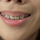 Beautiful Macro Shot of White Teeth with Braces - VideoHive Item for Sale
