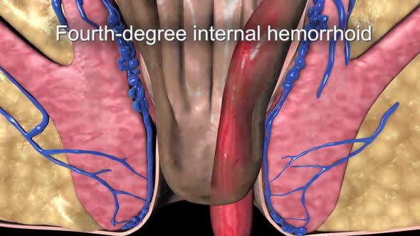 Hemorrhoids that prolapse and cannot be pushed back in the anal canal.