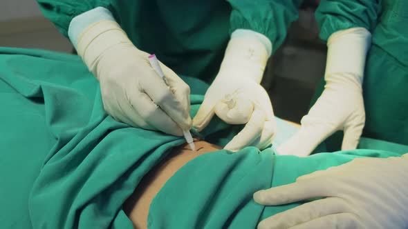 Close-up shot of surgeon doctor using marker draw line on belly for surgery in the operating room.