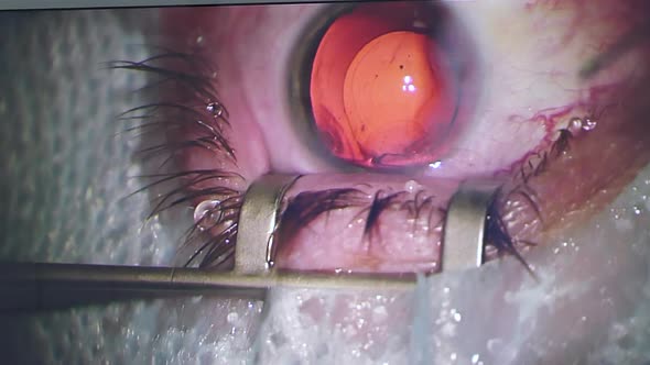 Closeup View of the Eye on the Laser Machine Screen During Vision Correction Surgery