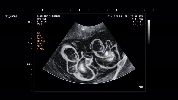 Analysis Of Children Health During Pregnancy By Medical Scanner Monitor