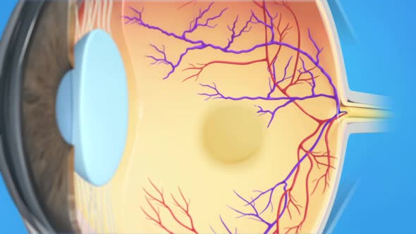 Central Retinal Vein Occlusion 3d medical