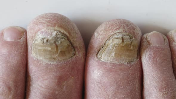 Closeup of a Foot with Damaged Nails Because of Fungus
