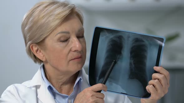 Female Oncologist Showing Lungs X-Ray and Shaking Head, Terminal Cancer Stage