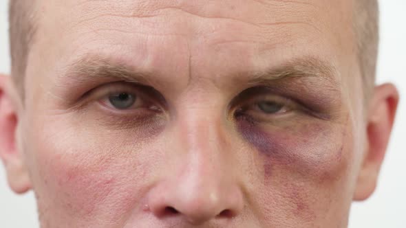 Bruise on the Eye of a Man
