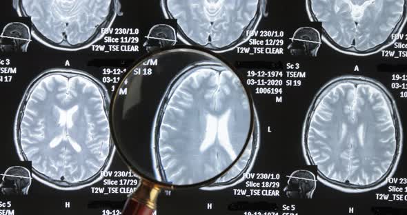 Mri Brain Scan Background Magnetic Resonance Tomography