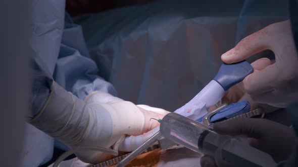 Closeup of Professional Doctor Hands Operating a Patient During Open Heart Surgery in Surgical Room