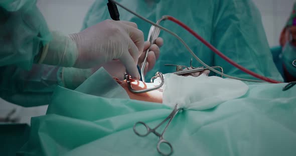 The Doctor Performs a Pediatric Surgical Operation to Remove the Tonsils