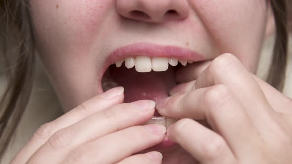 Mouth Closeup A Young Woman Puts a Corrective Aligner Splint on Her Lower Teeth to Correct an