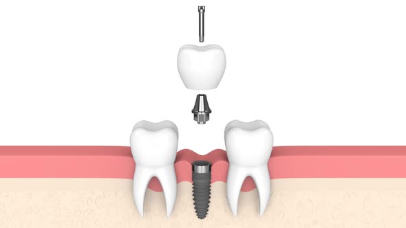 Dental implant placement into human gums over white background