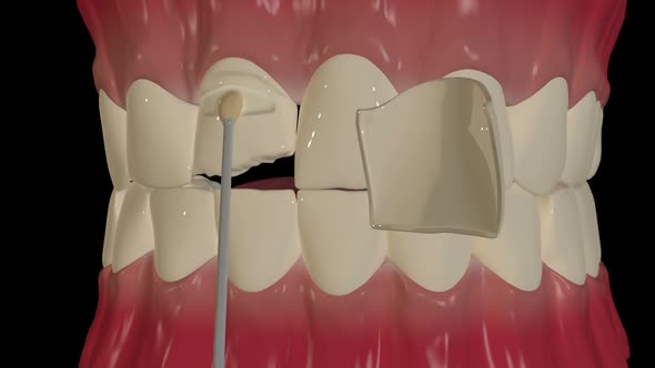 Dental Veneers Placement