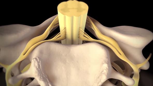A spinal disc herniation is an injury to the cushioning and connective tissue between the vertebrae.