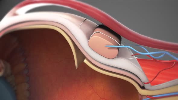 Medical Animation Of Eye Laser Treatment On Blue Background