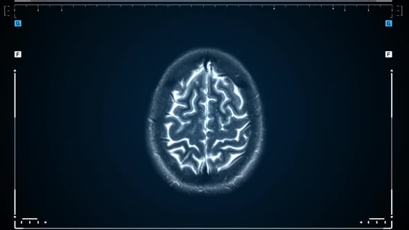 Brain MRI Scan