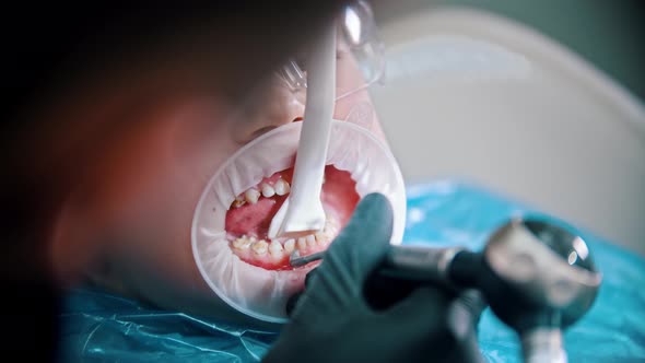 A Little Boy with Damaged Baby Teeth Having a Treatment in the Dentistry with an Opening Mouth Guard