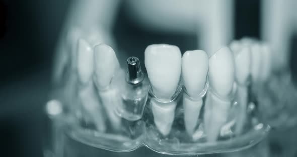 Transparent Model of Human Teeth with Implants Closeup