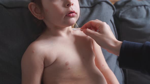 Toddler Girl with Chickenpox Measles on the Body