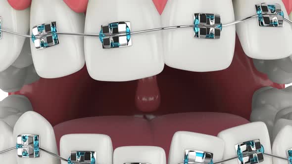 Teeth alignment by orthodontic metal braces isolated over white background