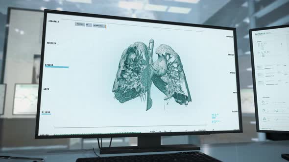 Innovative Medical X-ray Scanner Examination Of Lungs Diagnoses Cancer Disease