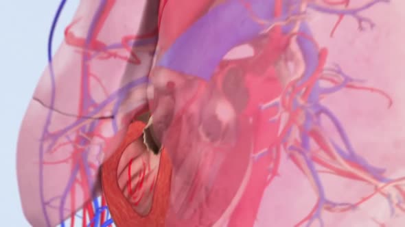 pulmonary embolism-blood clotting