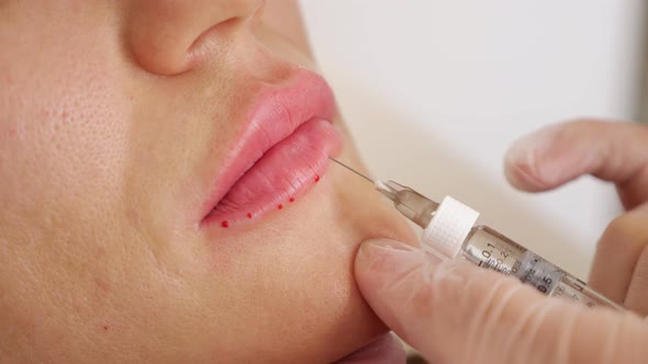 Closeup of a Doctor Making an Injection Into a Woman's Lower Lip