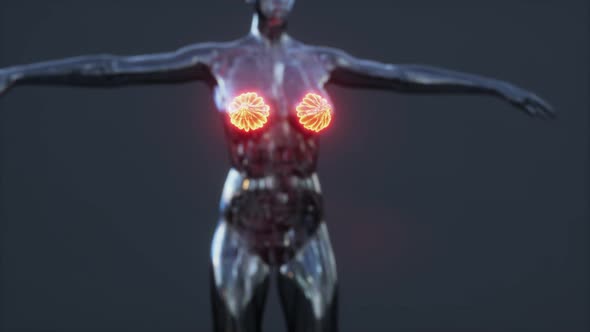 Female Breast with Cancer Focus of Inflammation alt