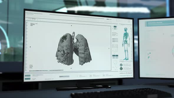 Hospital Therapy Scan Of Human Respiratory System Diagnosed Covid-19 Pneumonia alt